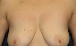 Breast Augmentation 06 Before