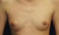 Breast Augmentation 02 Before