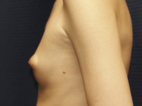 Breast Augmentation 02 Before 2