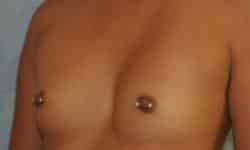 Breast Augmentation 03 Before