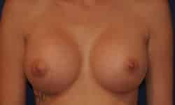 Breast Augmentation 02 After