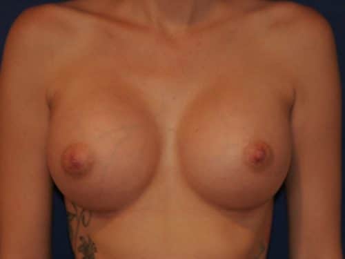 Breast Augmentation 02 After 1
