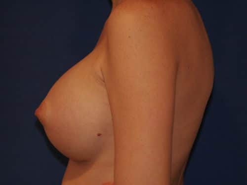 Breast Augmentation 02 After 2