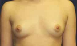 Breast Augmentation 08 Before