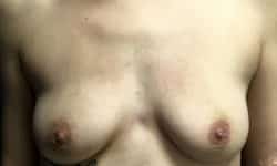 Breast Augmentation 01 Before