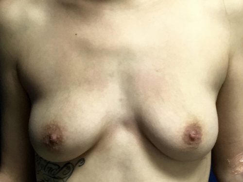 Breast Augmentation 01 Before 1
