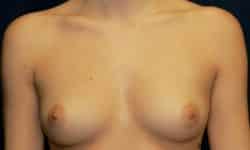Breast Augmentation 04 Before