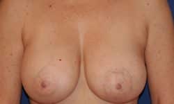Breast Augmentation 06 After