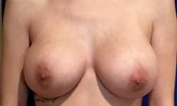 Breast Augmentation 01 After