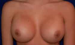 Breast Augmentation 04 After