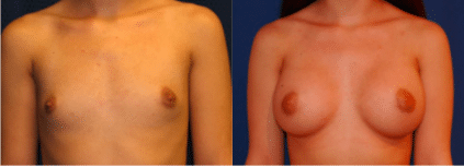 Before and After Breast Augmentation