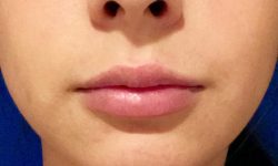 Lip Lift / Augmentation 04 After