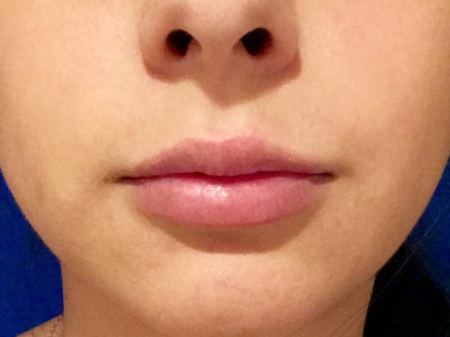 Lip Lift / Augmentation 04 After 1