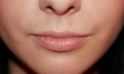 Lip Lift / Augmentation 04 Before