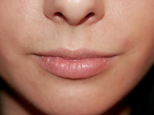 Lip Lift / Augmentation 04 Before 1