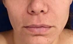 Lip Augmentation 5 Before