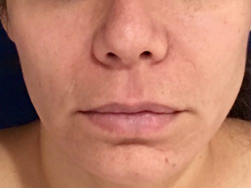 Lip Augmentation 5 Before 1