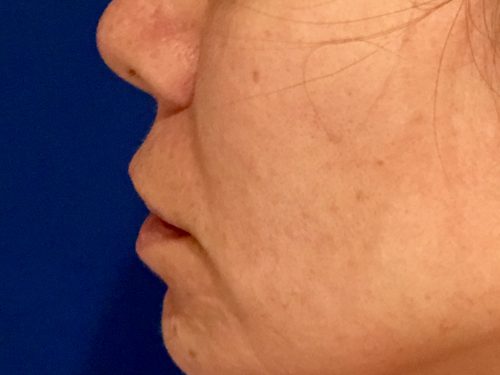 Lip Augmentation 5 Before 2