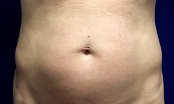 Liposuction 07 Before