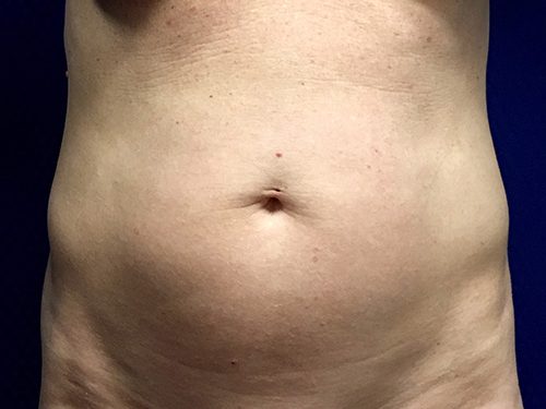 Liposuction 07 Before 1