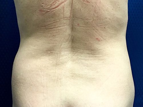 Liposuction 07 Before 2