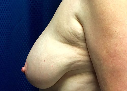 Breast Lift 06 Before 2