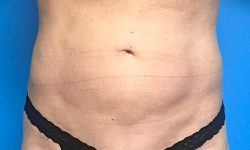 Liposuction 07 After