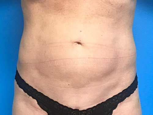 Liposuction 07 After 1