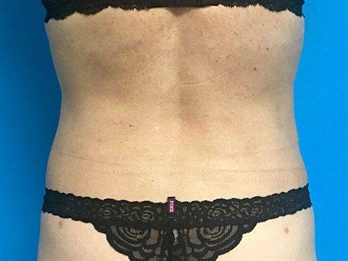 Liposuction 07 After 2