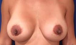 Breast Augmentation 12 After