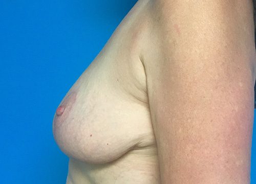 Breast Lift 06 After 2