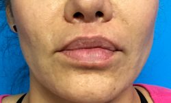 Lip Augmentation 5 After