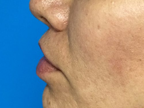 Lip Augmentation 5 After 2