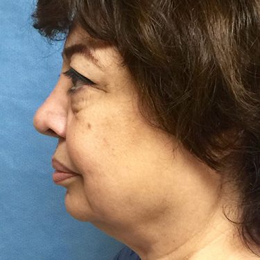 Facelift 12 Before 2