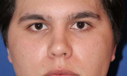 Buccal Fat Removal 03 After