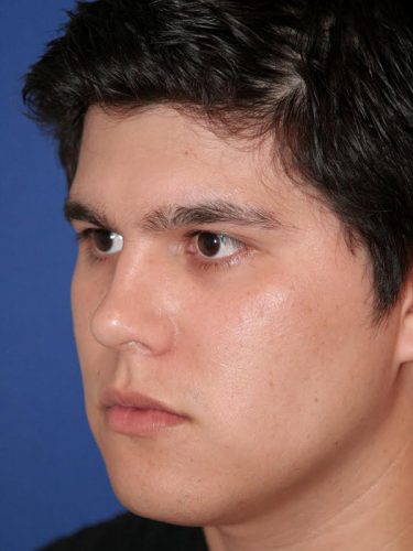 Buccal Fat Removal 03 After 2