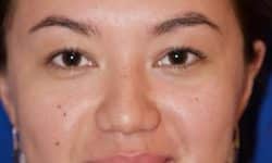 Buccal Fat Removal 04 Before