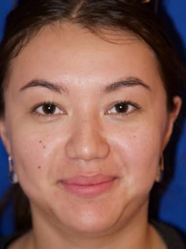 Buccal Fat Removal 04 Before 1