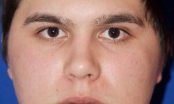 Buccal Fat Removal 03 Before