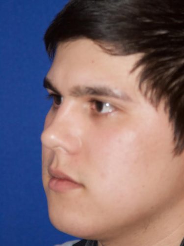 Buccal Fat Removal 03 Before 2