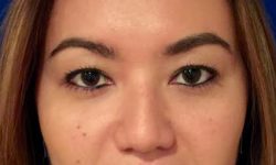 Buccal Fat Removal 04 After