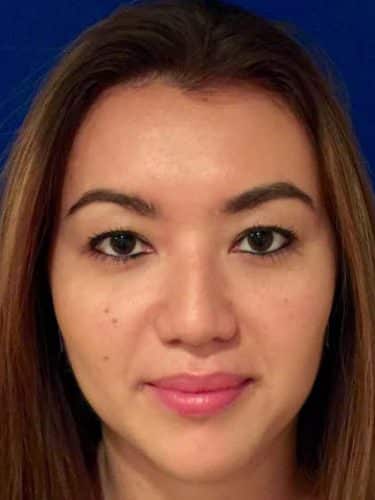 Buccal Fat Removal 04 After 1