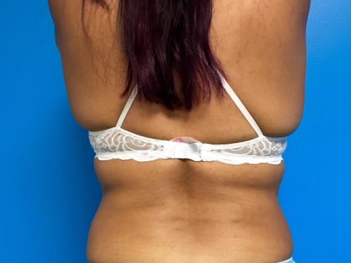 CoolSculpting 03 After 1