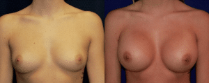 before-and-after-breast-augmentation