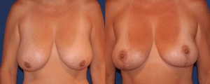 before-and-after-breast-lift-surgery