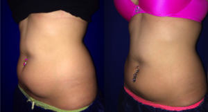 before-and-after-coolsculpting