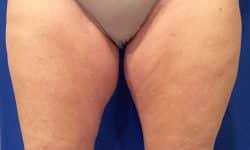 CoolSculpting 04 Before