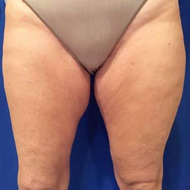 CoolSculpting 04 Before 1