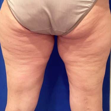 CoolSculpting 04 Before 2