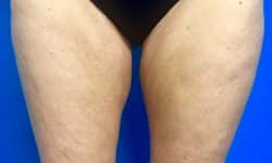 CoolSculpting 04 After